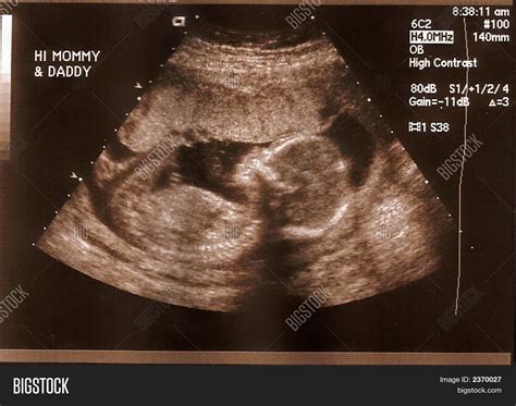 Ultrasound 18 Weeks Image & Photo (Free Trial) | Bigstock