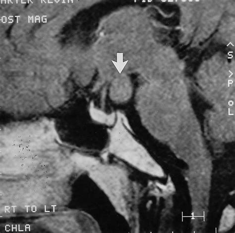 Hamartoma of tuber cinereum. T 1 weighted, gadolinium enhanced ...