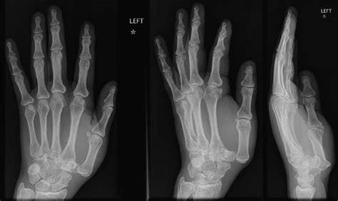 Thumb CMC Dislocation - Hand - Orthobullets