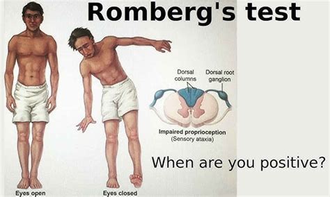 Romberg test or Romberg sign. How to perform & interpret a Romberg sign