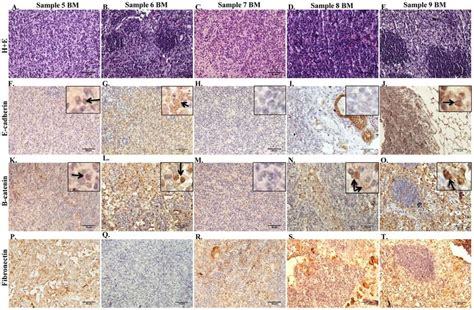 Expression of markers for epithelial and mesenchymal lineages in tumor ...