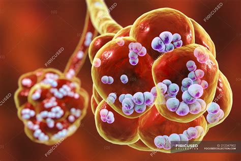 Digital artwork of Streptococcus pneumoniae bacteria inside alveoli of lung causing pneumonia ...