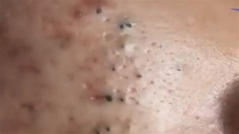 Full Blackhead Popping Video HOT 2019 Part 98 - YouTube