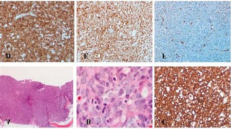 Bone marrow trephine biopsy results. Morphology and... | Download Scientific Diagram