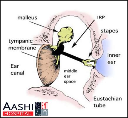 Ossiculoplasty - Ear Surgery & Hearing Loss Treatment in Ahmedabad