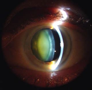 What is a Cataract? - Eyedolatry