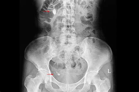 Ureter Stent Removal: What You Need to Know | Cardiovascular Disorders and Diseases medical ...