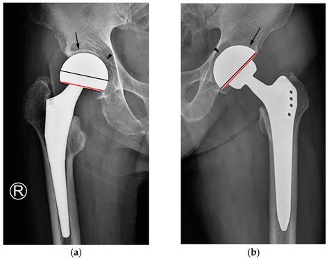 JCM | Free Full-Text | Deviation of Latitude Cut: A Simple Sign to ...