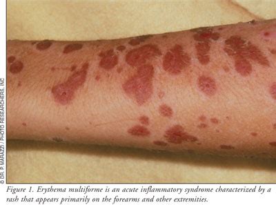 Cutaneous Adverse Reactions: Stevens-Johnson Syndrome