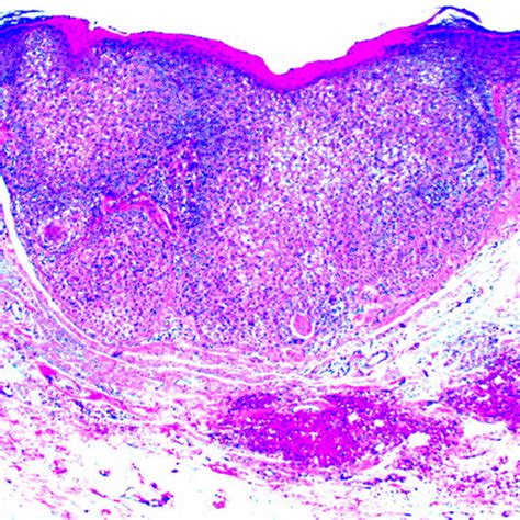 Pathology Outlines - Trichilemmoma