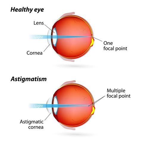 What Does Astigmatism Look Like