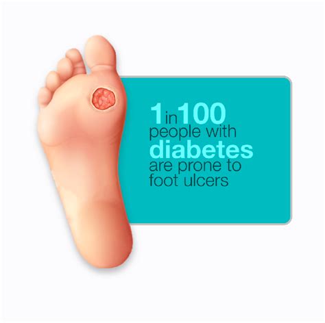 Diabetic Foot Ulcers Risk Factors Symptoms Treatment