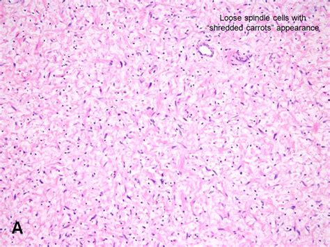 Neurofibroma - American Urological Association