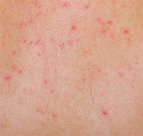 What Causes Petechiae in Children? (with pictures)