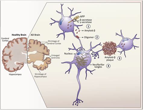 Down syndrome and Alzheimer's disease: common molecular traits beyond ...