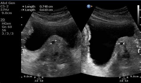 Prostate Cyst Ultrasound