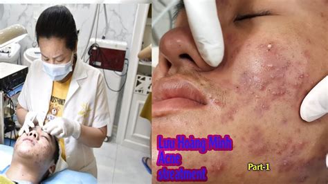 Acne treatment reputation, effective at Hien Van Spa|380I Lưu hoàng Minh - YouTube