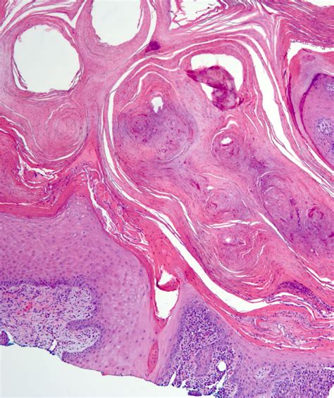 Keratoacanthoma Histology