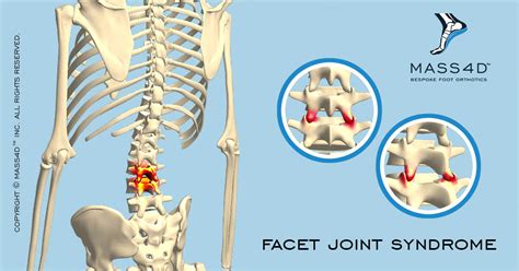 What is Facet Joint Syndrome?