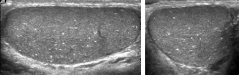 Primary Health Station: Testicular Microlithiasis: Can It Cause Cancer?