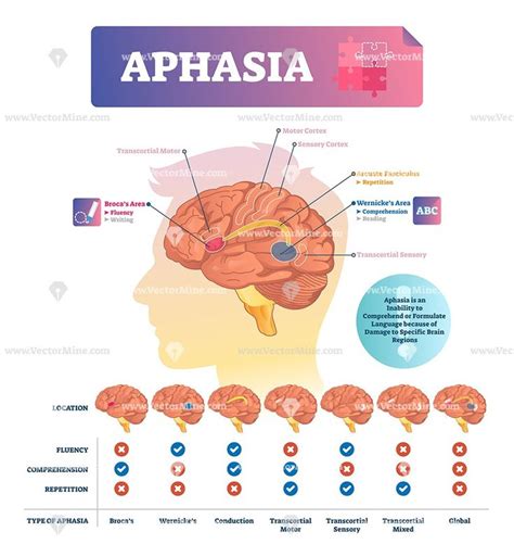 Aphasia vector illustration – VectorMine | Aphasia, Speech language pathology grad school ...