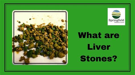 Dr Maran - What are Liver Stones - YouTube