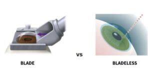 Microkeratome Lasik: Meaning, How It Works, Benefits And Risks