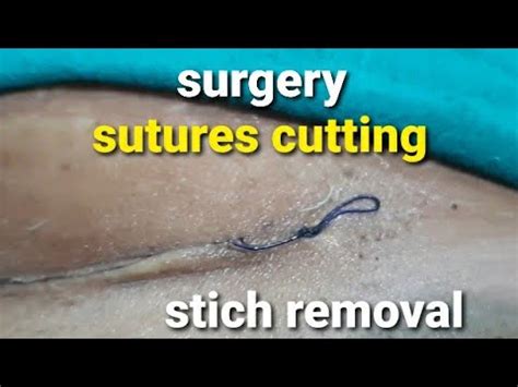 Stiches removal and dressing after cesarean section || घुलनशील टाँको को काटना || suture removal ...