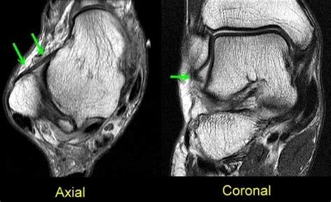 Mri Ankle Anatomy Ligaments