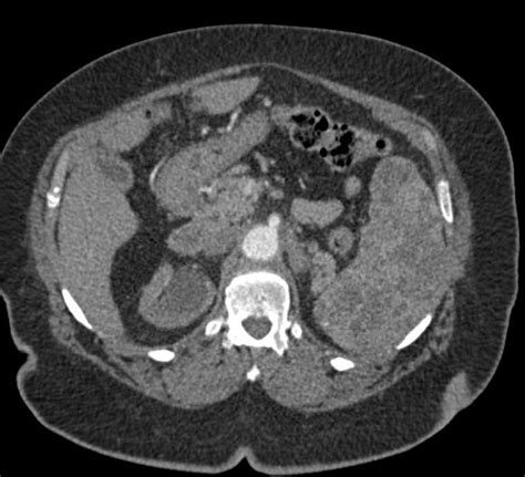 Multiple Splenic Hemangiomas - Spleen Case Studies - CTisus CT Scanning