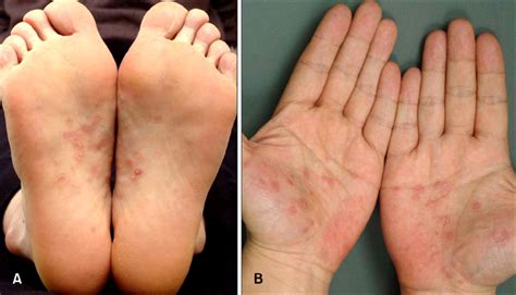 A Case of Palmoplantar Lichen Planus Mimicking Secondary Syphilis