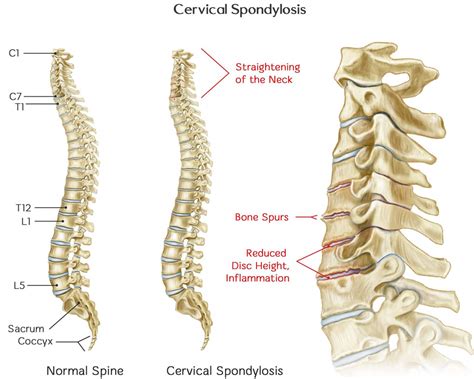 Cervical Spondylosis - Causes, Symptoms, Exercises, Treatment