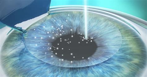 Best 10 Recommended LASIK Clinics in Singapore: Price and Reviews 2023