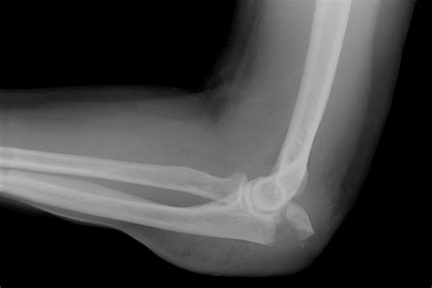 Elbow X Ray Fracture