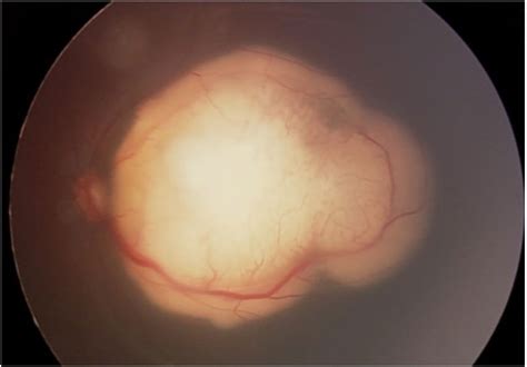 Frontiers | Retinoblastoma: Review and new insights