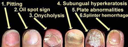 Nail pitting: Nail pitting causes