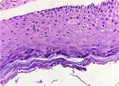 Odontogenic Keratocyst Histology