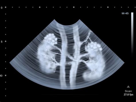 Renal Ultrasound Scan