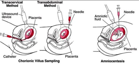 Chorionic Villus Sampling - What is?, Definition, Risks, Procedure, Contraindications, Results ...