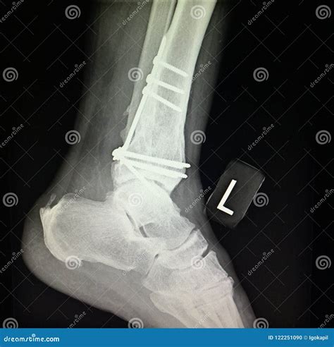 Ankle Left Tibia Distal Fracture Treatment Xray Royalty-Free Stock Photo | CartoonDealer.com ...