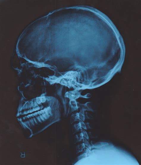 Lateral Skull X-Ray by AGP12 on DeviantArt