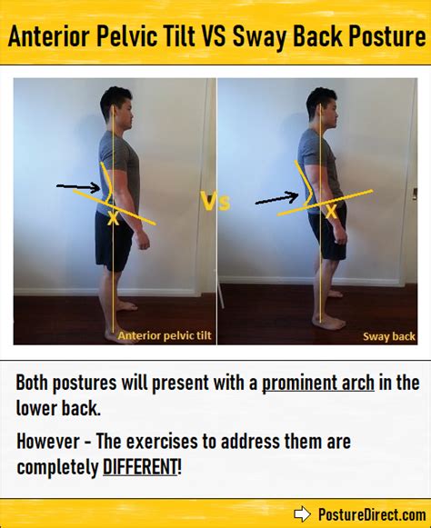 Mark Wong - Anterior Pelvic Tilt 🆚 Sway Back Posture It...