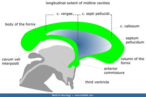 Cavum septi pellucidi and cavum vergae | MedLink Neurology