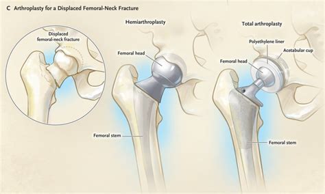 Common Types of Hip Replacement — Han Orthopaedics