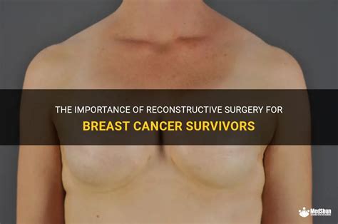 The Importance Of Reconstructive Surgery For Breast Cancer Survivors ...