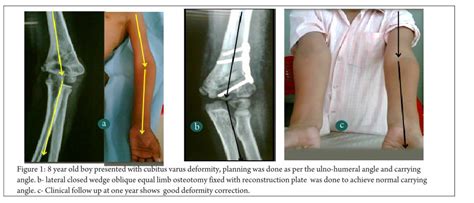 Cubitus varus Archives - International Journal of Paediatric Orthopaedics