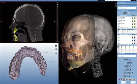 What Is A Cone Beam Scan - The Best Picture Of Beam