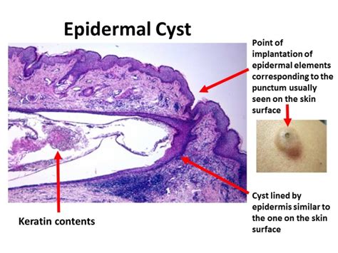 Epidermal Cyst | ROJoson Medical Clinic