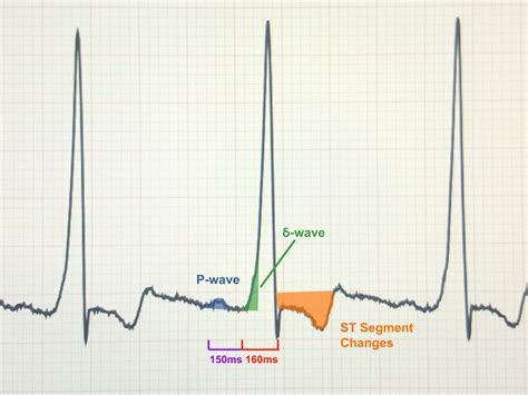 Wolff Parkinson White Syndrome - Causes, Symptoms, Treatment