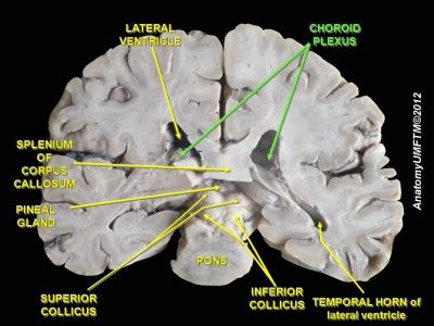 choroid_plexus_2 | Medical Science Navigator